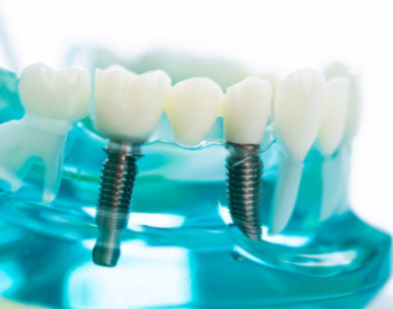 dental-implants-dentist-mississauga
