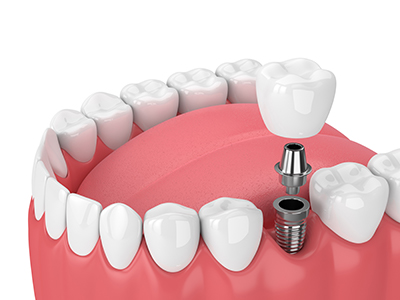 dental-implants-mississauga-dentist