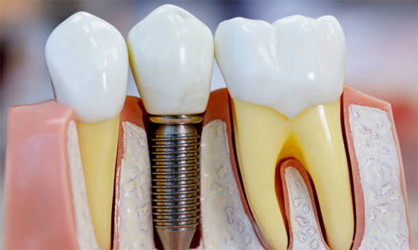 dental-implants-mississauga-dentist