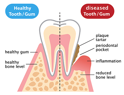 gum-disease-mississauga-dentist
