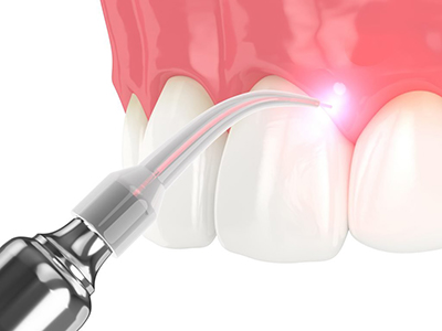 laser-dentistry-mississauga-dentist