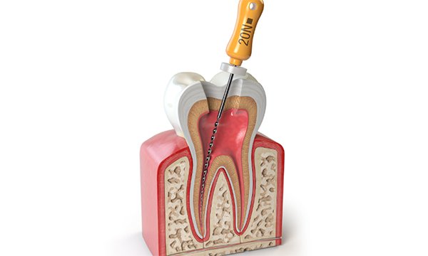 root-canal-mississauga-dentist