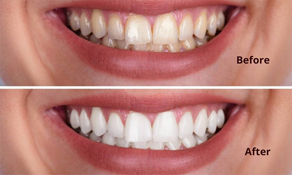 teeth-whitening-mississauga-dentist
