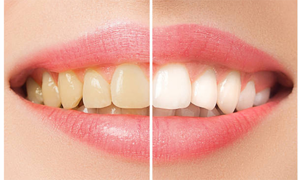 teeth-whitening-mississauga-dentist