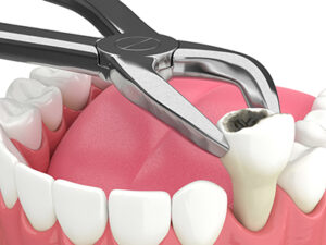 tooth-extraction-mississauga-dentist